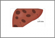 Hepatitis A