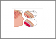 Meningitis